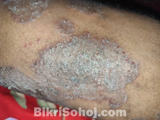 স্কাবিজ বা যে কোন চুলকানি থেকে মুক্তি পান মাত্র কয়েক দিনে!